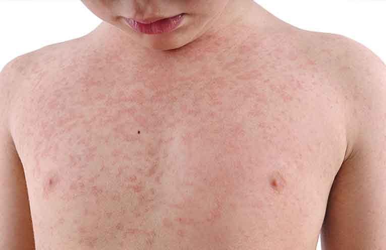 Measles is about – check that your immunisations are up to date